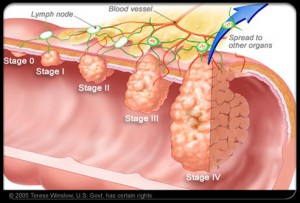 colorectal cancer