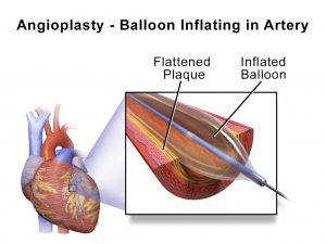 treatment for coronary artery blockages