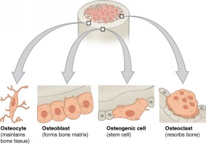 osteoporosis