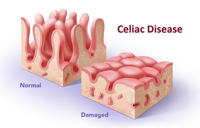 Celiac Chart