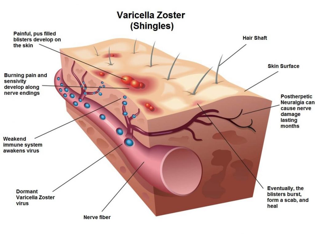 shingles