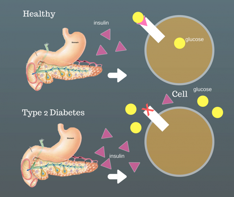 Еда инсулин. Type 2 Diabetes. Инфографика инсулин. Инсулин в еде. Инсулин и еда картинки.