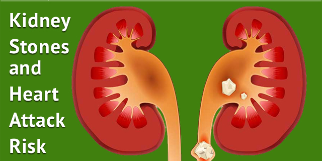 Kidney Stones and the Risk of Heart Attack and Stroke